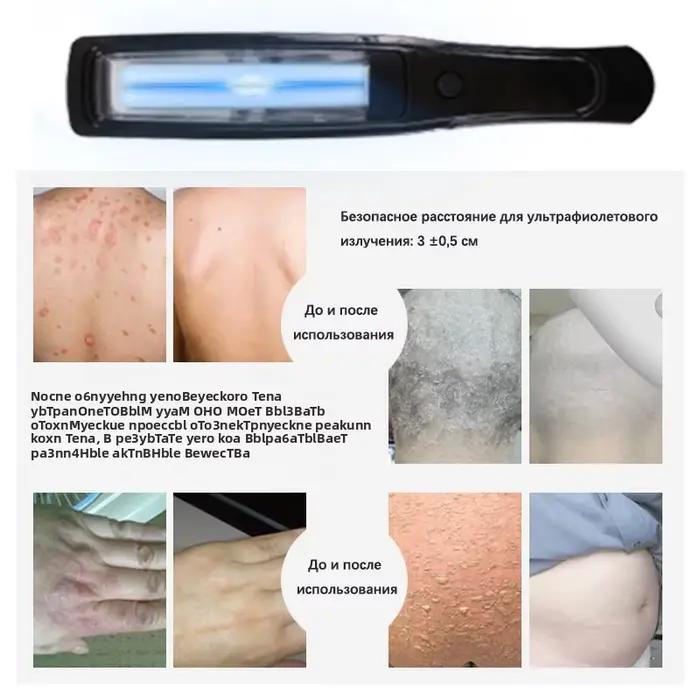 Lampe UVB pour la thérapie du psoriasis, lampe de traitement cutané, lumière ultraviolette à bande étroite 311 nm, instrument de photothérapie pour le vitiligo